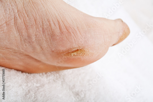 Photo: Feet that need a pedicure Feet that need a pedicure