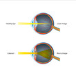 Human Eye Cataract Illustration