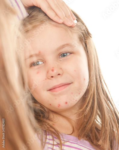 Photo: A girl suffering from varicella A girl suffering from varicella
