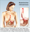 Blut-Erbrechen, Brechreiz, Uebelkeit