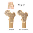 osteoporosis medical vector illustration osteoporosis medical vector illustration