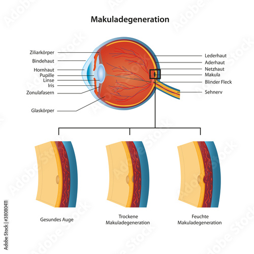 Vector: makuladegeneration vektor illustration deutsch mit beschreibung makuladegeneration vektor illustration deutsch mit beschreibung