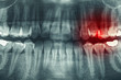 Foto: Panoramic dental xray, with red painful area Panoramic dental xray, with red painful area