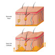 cellulite skin vector illustration eps10