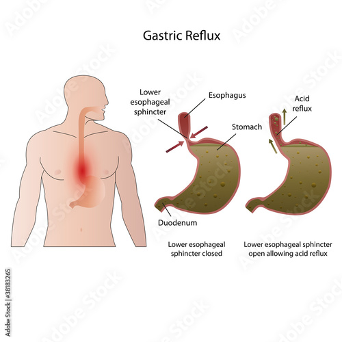 Vector: Gastroesophageal reflux disease medical vector illustration Gastroesophageal reflux disease medical vector illustration