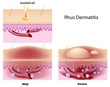 Urushiol oil induced contact dermatitis, eps8