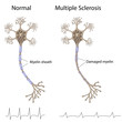 Multiple sclerosis, eps8