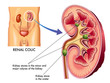 colica renale