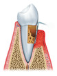 advanced periodontitis