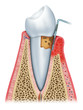 periodontitis half