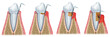 Sequence of Periodontitis