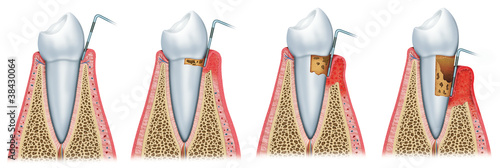 Illustration: Sequence of Periodontitis Sequence of Periodontitis