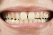 Spacing Teeth Spacing Teeth