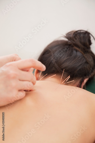 Photo: Acupuncture needles on back Acupuncture needles on back