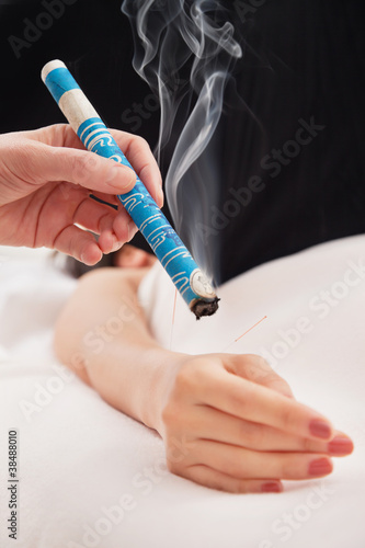 Photo: Hand applying moxa stick Hand applying moxa stick