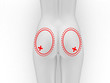 Chirurgia plastica al sedere