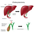 Cholecystectomy gallbladder removal surgery, eps8