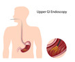 Upper gastrointestinal endoscopy, eps8