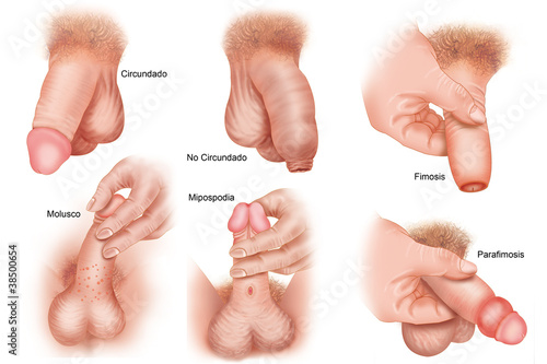 Illustration: venereal diseases venereal diseases