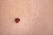Mole On The Skin