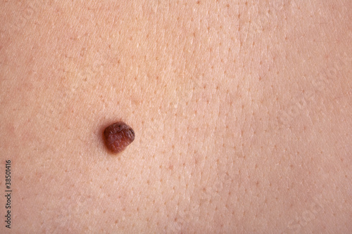 Photo: Mole on the skin Mole on the skin