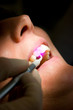 Foto: Dental Laser bei Zahnfleisch Behandlung Dental Laser bei Zahnfleisch Behandlung