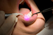 Foto: Dental Laser Zahnfleisch Zahnarzt Behandlung Dental Laser Zahnfleisch Zahnarzt Behandlung