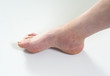 ankle sprain
