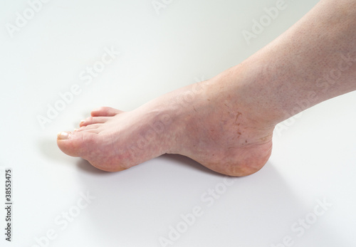 Photo: ankle sprain ankle sprain