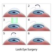 Lasik eye surgery procedure, eps10