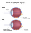 Lasik eye surgery for myopia, eps8