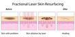 Fractional Laser Skin Resurfacing, eps10