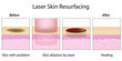 Laser Skin Resurfacing, eps10