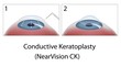 Conductive Keratoplasty eye surgery, eps10