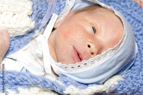 Photo: newborn infant with allergic diathesis newborn infant with allergic diathesis