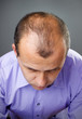 Loosing hair
