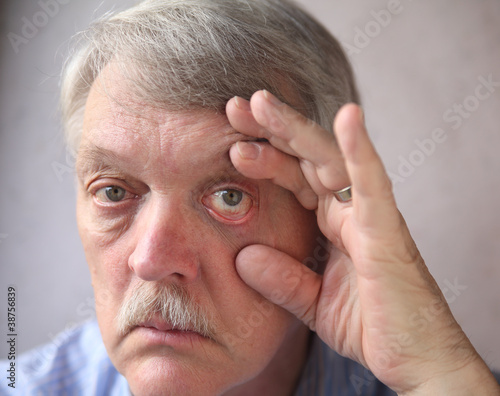 Photo: bloodshot eyes in a senior man bloodshot eyes in a senior man
