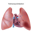 Pulmonary embolism, eps10