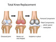 Total knee replacement surgery, eps10