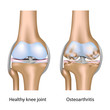 Osteoarthritis of knee joint, eps10