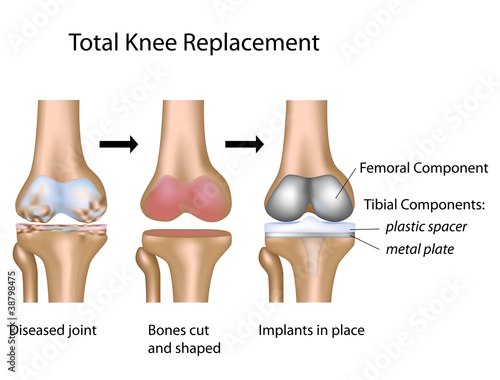 Vector: Total knee replacement surgery, eps10 Total knee replacement surgery, eps10