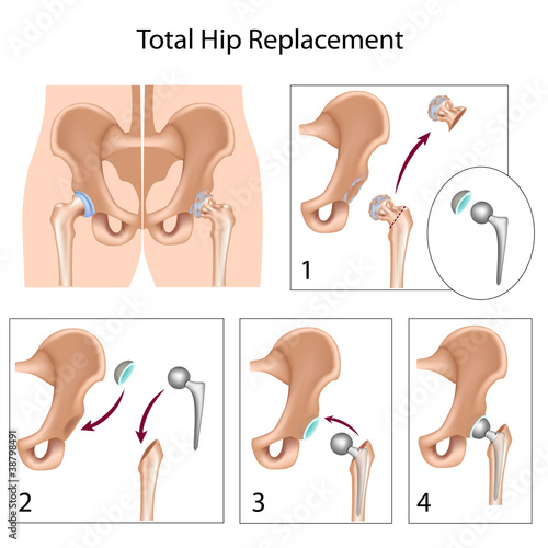 Vector: Total hip replacement surgery, eps10 Total hip replacement surgery, eps10