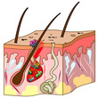 Vector: Scheme of skin with acne Scheme of skin with acne