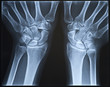 Wrist X-ray. Female.