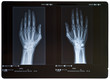 X-ray of hands. Female.
