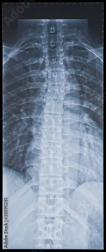 Photo: Back X-ray showing scoliosis (curvature). 2 views. Female. Back X-ray showing scoliosis (curvature). 2 views. Female.