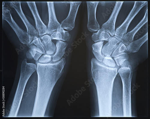 Photo: Wrist X-ray. Female. Wrist X-ray. Female.