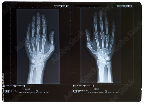 Photo: X-ray of hands. Female. X-ray of hands. Female.