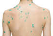 chicken pox