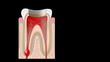 Root canal treatment animation